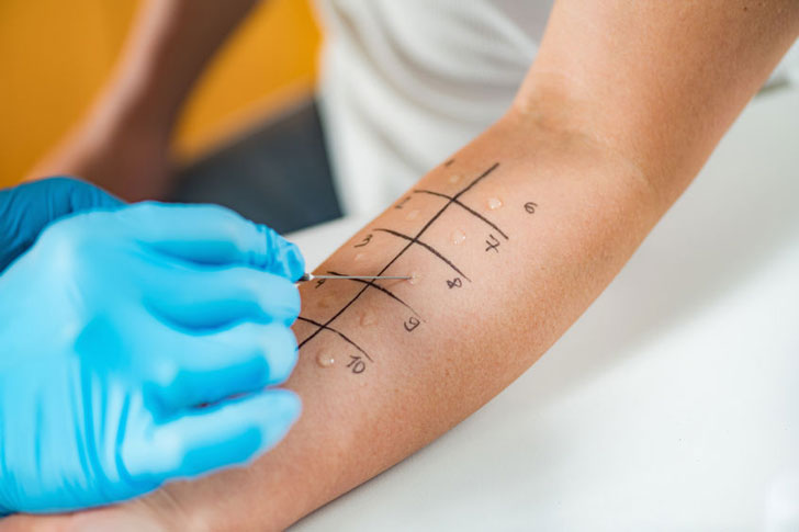 Cannabis allergies can be diagnosed with a skin test